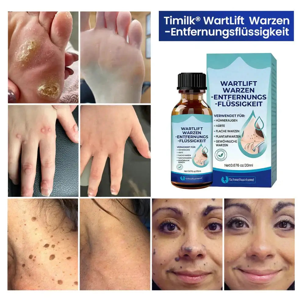 WartLift Wart Removal Fluid