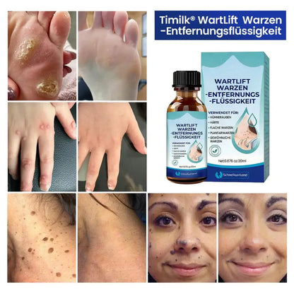 WartLift Wart Removal Fluid